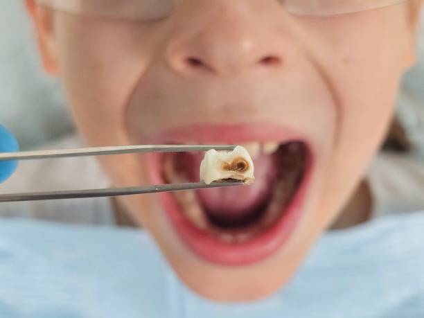 Best Broken or Cracked Tooth Emergency Dentist in Albany, MO